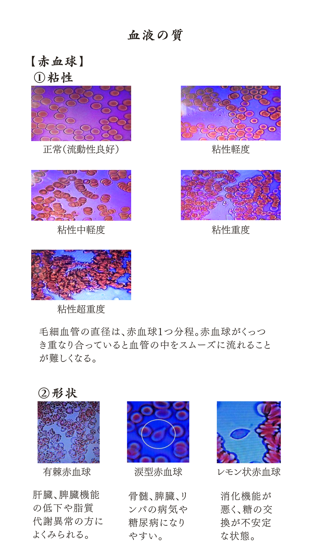 血液観察資料 2ページ：血液の質 赤血球の粘性と形状